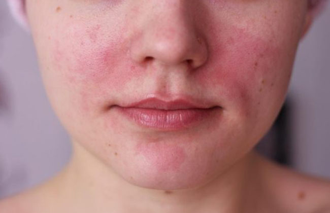 Аллергия на лице фото 1